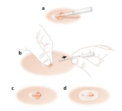 Nursing guideline subcut devices insuflon insertion3